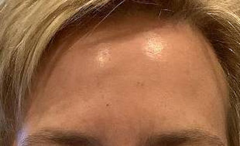Botox Before & After Gallery - Patient 287741 - Image 2 - Scott Chapin, MD