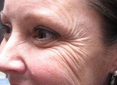 Botox Before & After Gallery - Patient 162574 - Image 1 - Scott Chapin, MD