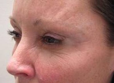 Botox Before & After Gallery - Patient 162574 - Image 2 - Scott Chapin, MD