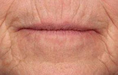 Botox Before & After Gallery - Patient 319039 - Image 1 - Scott Chapin, MD