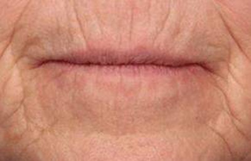 Botox Before & After Gallery - Patient 319039 - Image 1 - Scott Chapin, MD