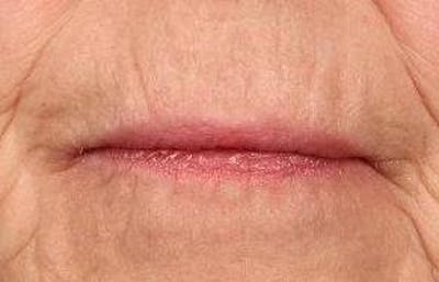 Botox Before & After Gallery - Patient 319039 - Image 2 - Scott Chapin, MD