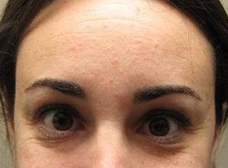 Botox Before & After Gallery - Patient 128555 - Image 1 - Scott Chapin, MD