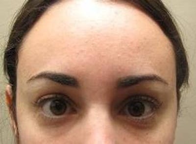 Botox Before & After Gallery - Patient 128555 - Image 2 - Scott Chapin, MD