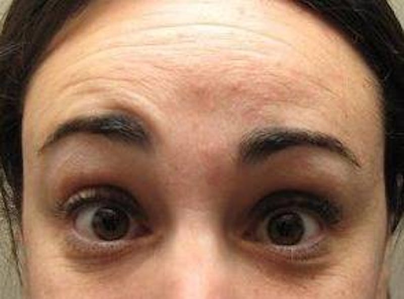 Botox Before & After Gallery - Patient 128555 - Image 3 - Scott Chapin, MD