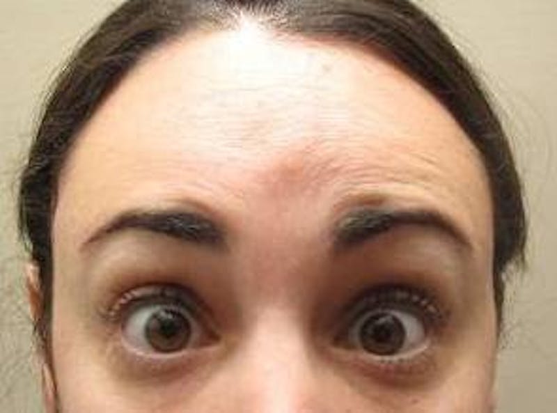 Botox Before & After Gallery - Patient 128555 - Image 4 - Scott Chapin, MD