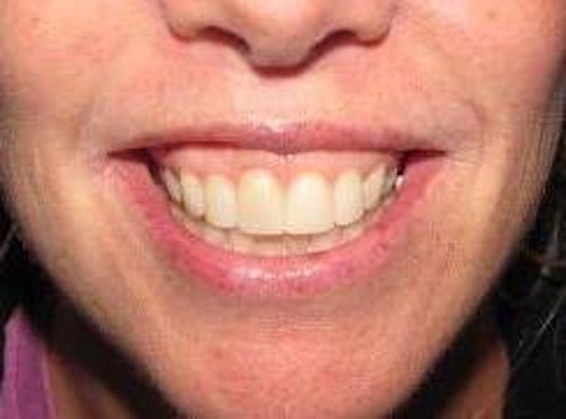 Botox Before & After Gallery - Patient 301874 - Image 1 - Scott Chapin, MD