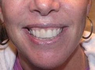 Botox Before & After Gallery - Patient 301874 - Image 2 - Scott Chapin, MD