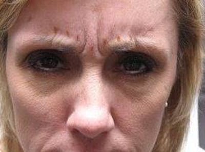 Botox Before & After Gallery - Patient 280360 - Image 1 - Scott Chapin, MD