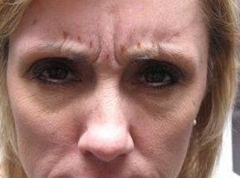 Botox Before & After Gallery - Patient 280360 - Image 1 - Scott Chapin, MD