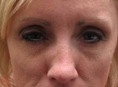 Botox Before & After Gallery - Patient 280360 - Image 2 - Scott Chapin, MD