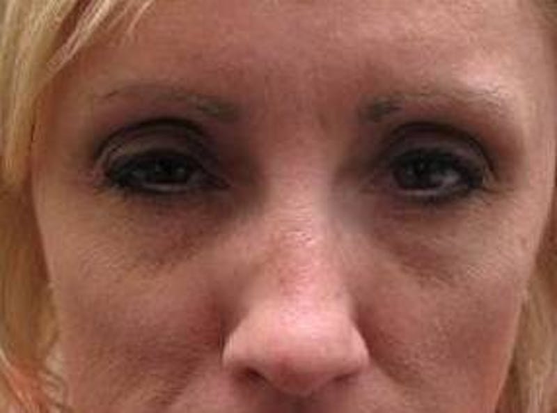 Botox Before & After Gallery - Patient 280360 - Image 2 - Scott Chapin, MD