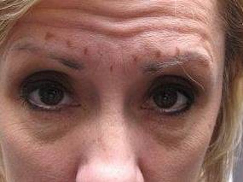 Botox Before & After Gallery - Patient 280360 - Image 3 - Scott Chapin, MD