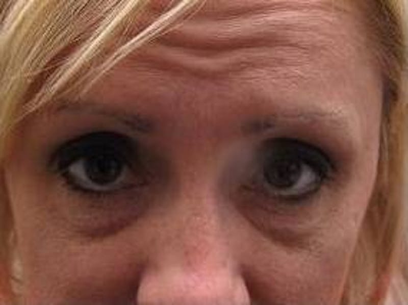 Botox Before & After Gallery - Patient 280360 - Image 4 - Scott Chapin, MD