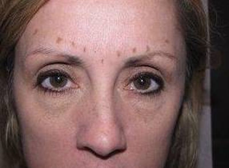 Botox Before & After Gallery - Patient 280360 - Image 5 - Scott Chapin, MD