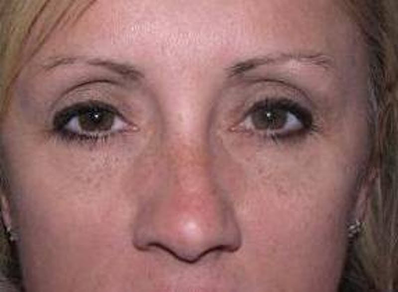 Botox Before & After Gallery - Patient 280360 - Image 6 - Scott Chapin, MD
