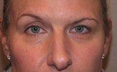Botox Before & After Gallery - Patient 282094 - Image 1 - Scott Chapin, MD