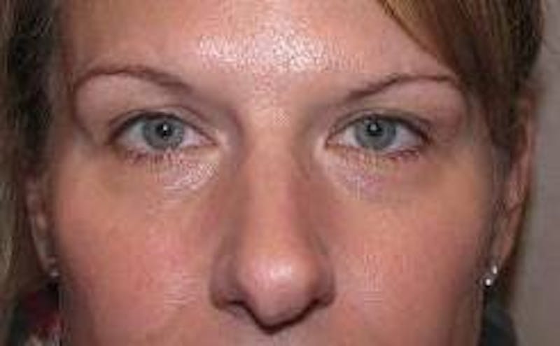 Botox Before & After Gallery - Patient 282094 - Image 2 - Scott Chapin, MD