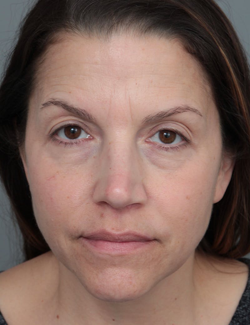 Dermal Fillers Before & After Gallery - Patient 348566 - Image 1 - Scott Chapin, MD