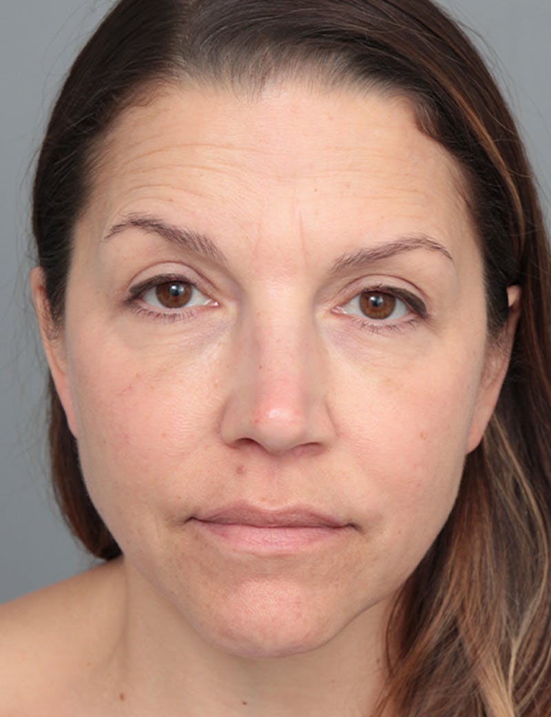 Dermal Fillers Before & After Gallery - Patient 348566 - Image 2 - Scott Chapin, MD