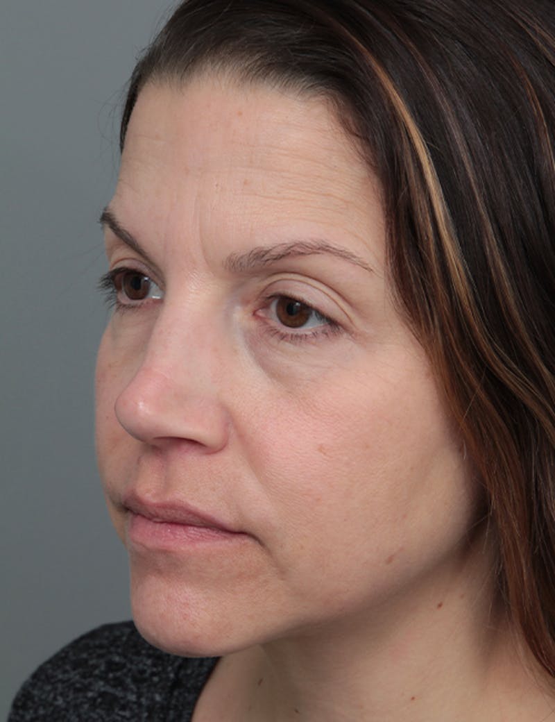 Dermal Fillers Before & After Gallery - Patient 348566 - Image 3 - Scott Chapin, MD