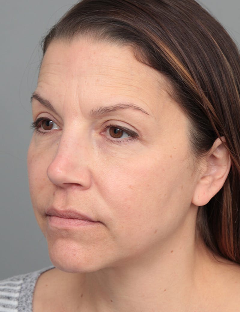 Dermal Fillers Before & After Gallery - Patient 348566 - Image 4 - Scott Chapin, MD