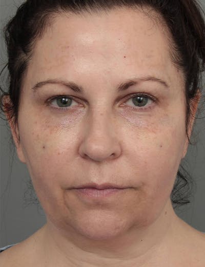 Dermal Fillers Before & After Gallery - Patient 363203 - Image 1 - Scott Chapin, MD