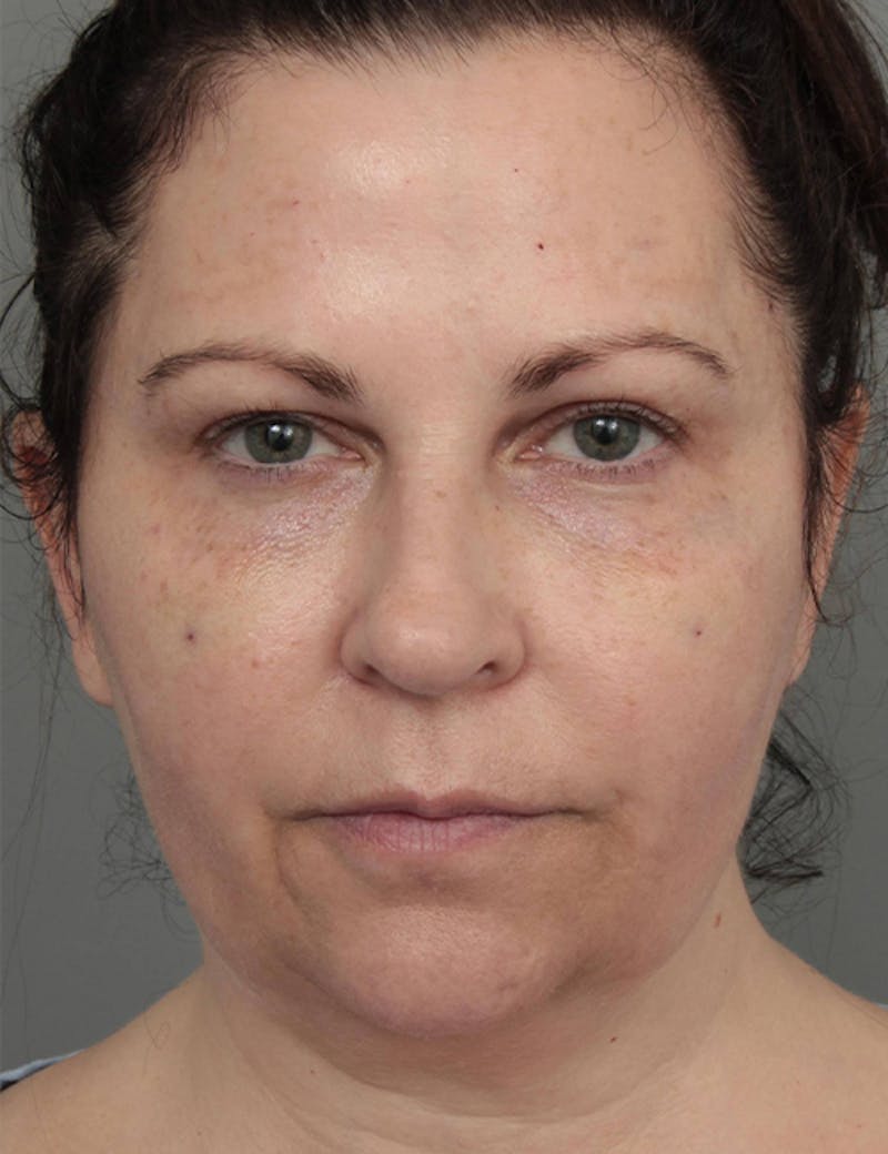 Dermal Fillers Before & After Gallery - Patient 363203 - Image 1 - Scott Chapin, MD