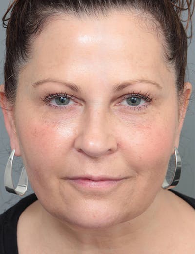 Dermal Fillers Before & After Gallery - Patient 363203 - Image 2 - Scott Chapin, MD