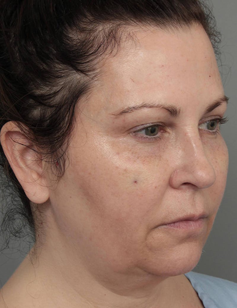 Dermal Fillers Before & After Gallery - Patient 363203 - Image 3 - Scott Chapin, MD