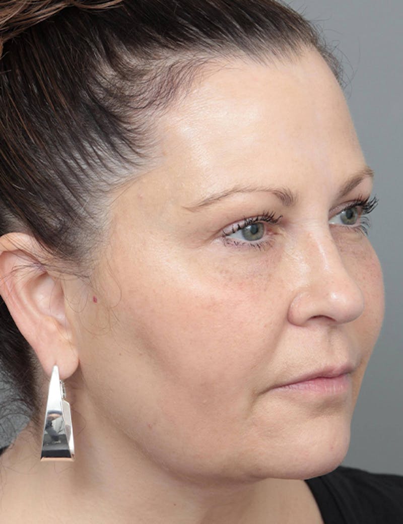 Dermal Fillers Before & After Gallery - Patient 363203 - Image 4 - Scott Chapin, MD
