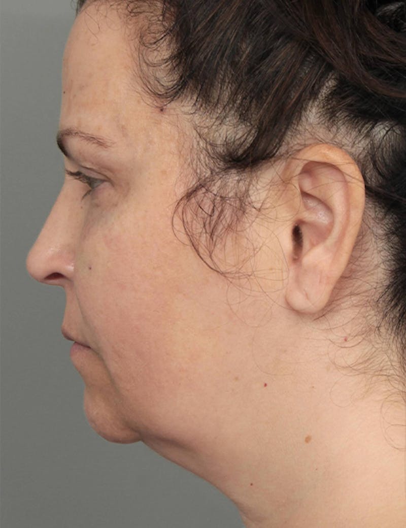 Dermal Fillers Before & After Gallery - Patient 363203 - Image 5 - Scott Chapin, MD