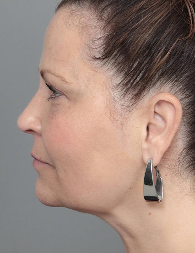 Dermal Fillers Before & After Gallery - Patient 363203 - Image 6 - Scott Chapin, MD