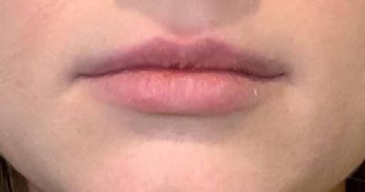 Dermal Fillers Before & After Gallery - Patient 265049 - Image 1 - Scott Chapin, MD
