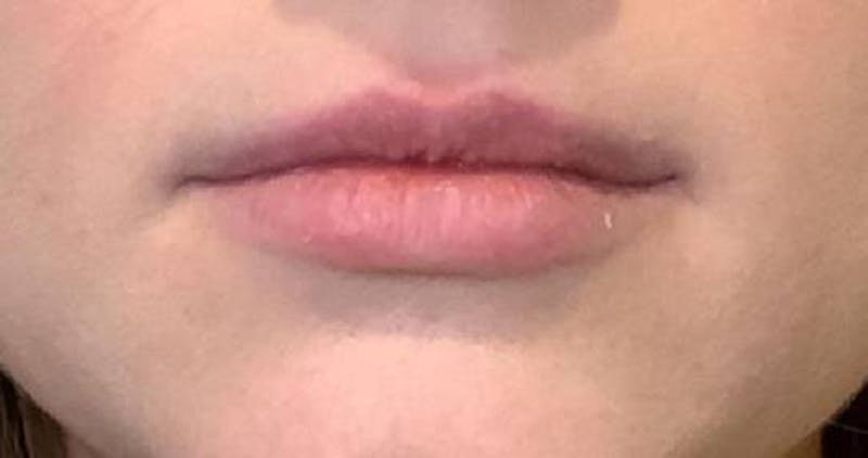 Dermal Fillers Before & After Gallery - Patient 265049 - Image 1 - Scott Chapin, MD