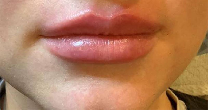 Dermal Fillers Before & After Gallery - Patient 265049 - Image 2 - Scott Chapin, MD