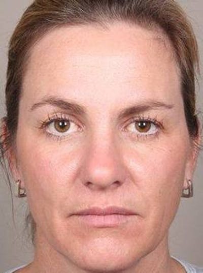 Dermal Fillers Before & After Gallery - Patient 301683 - Image 1 - Scott Chapin, MD