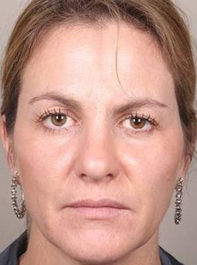 Dermal Fillers Before & After Gallery - Patient 301683 - Image 2 - Scott Chapin, MD