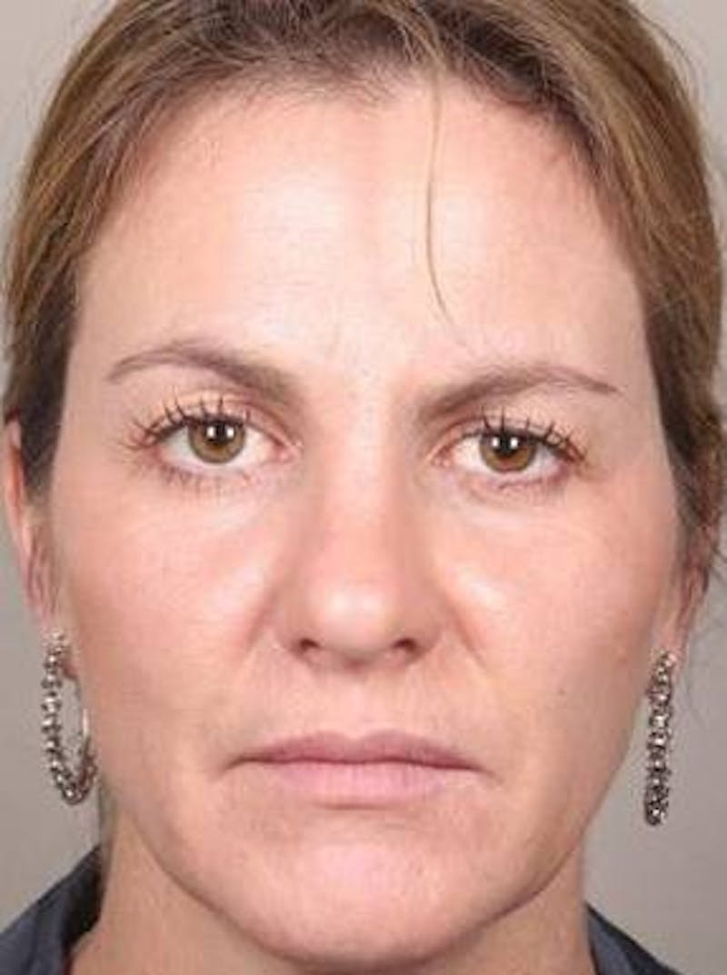 Dermal Fillers Before & After Gallery - Patient 301683 - Image 2 - Scott Chapin, MD