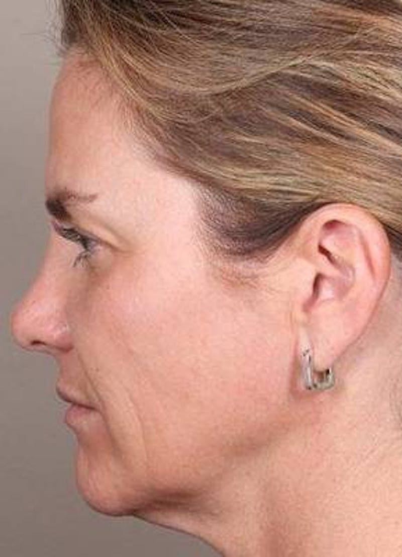 Dermal Fillers Before & After Gallery - Patient 301683 - Image 3 - Scott Chapin, MD