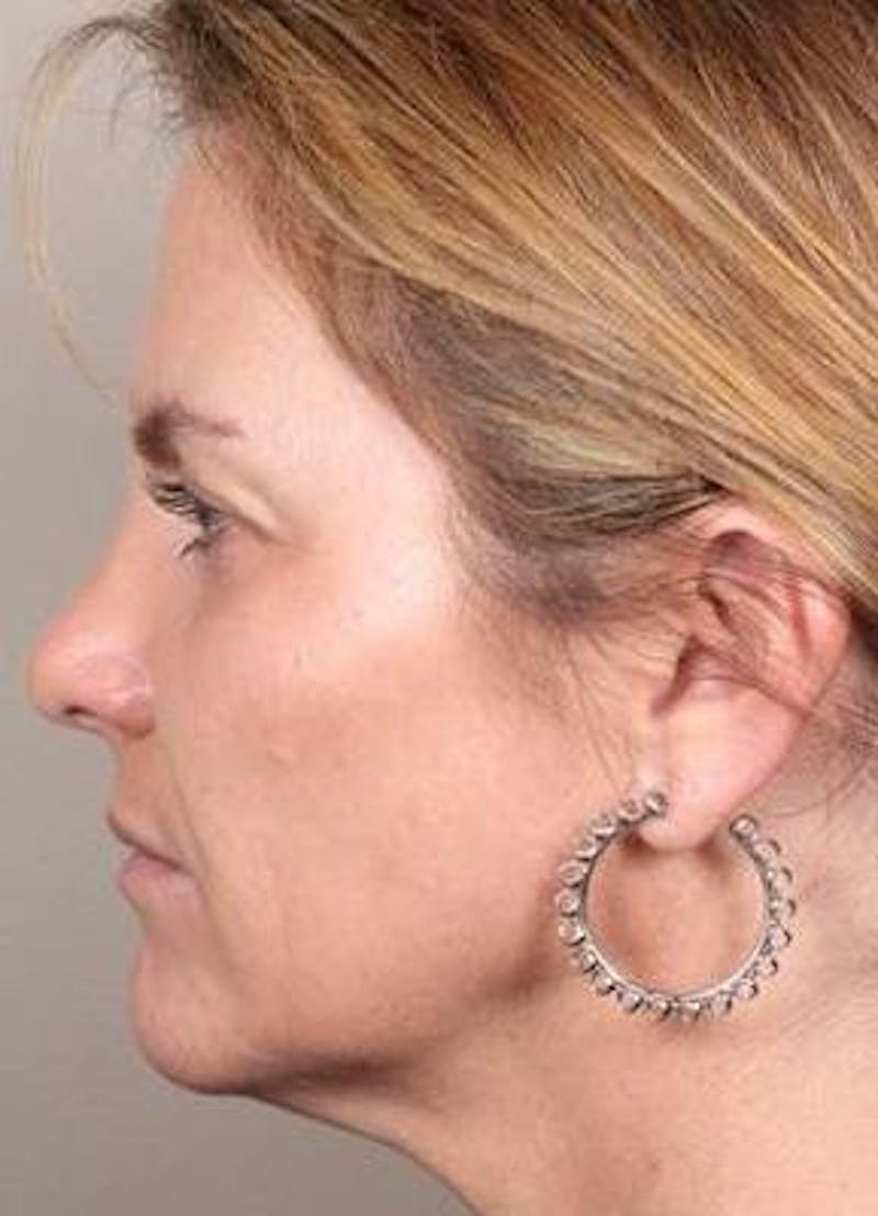 Dermal Fillers Before & After Gallery - Patient 301683 - Image 4 - Scott Chapin, MD