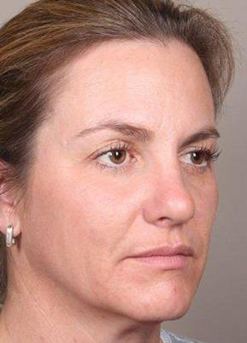 Dermal Fillers Before & After Gallery - Patient 301683 - Image 5 - Scott Chapin, MD