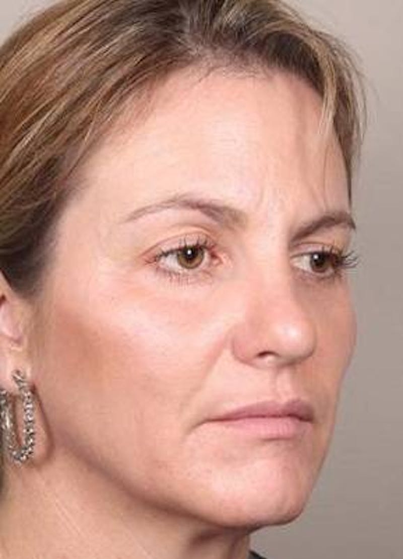 Dermal Fillers Before & After Gallery - Patient 301683 - Image 6 - Scott Chapin, MD