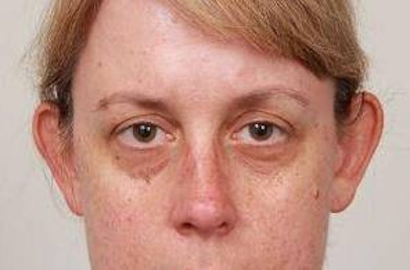 Dermal Fillers Before & After Gallery - Patient 375817 - Image 1 - Scott Chapin, MD