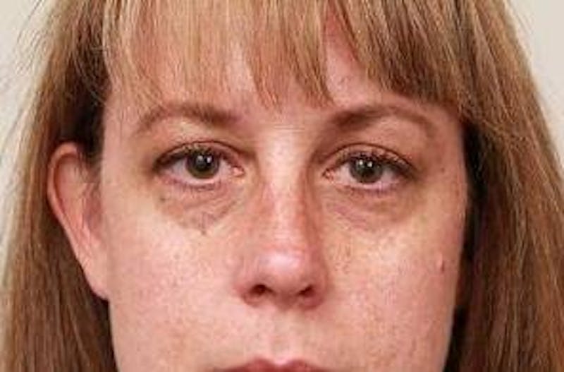 Dermal Fillers Before & After Gallery - Patient 375817 - Image 2 - Scott Chapin, MD