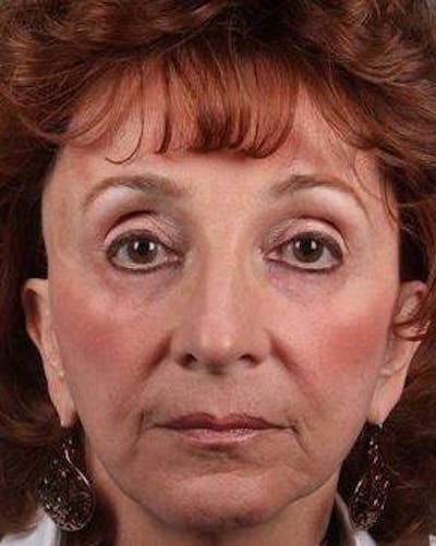 Dermal Fillers Before & After Gallery - Patient 301639 - Image 1 - Scott Chapin, MD