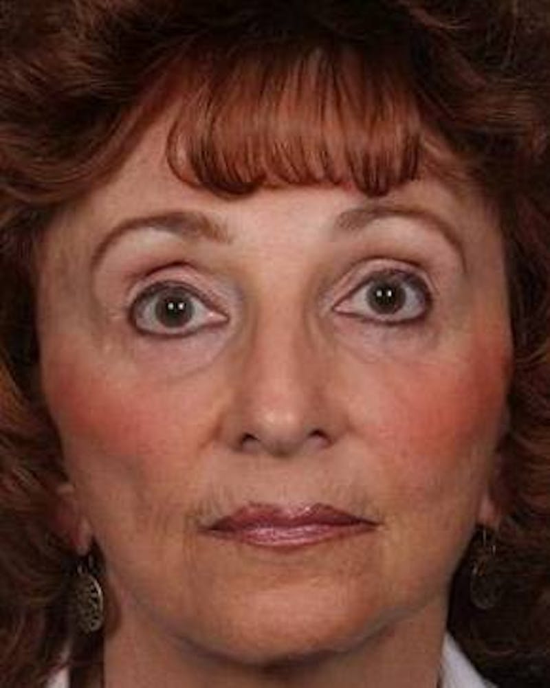 Dermal Fillers Before & After Gallery - Patient 301639 - Image 2 - Scott Chapin, MD