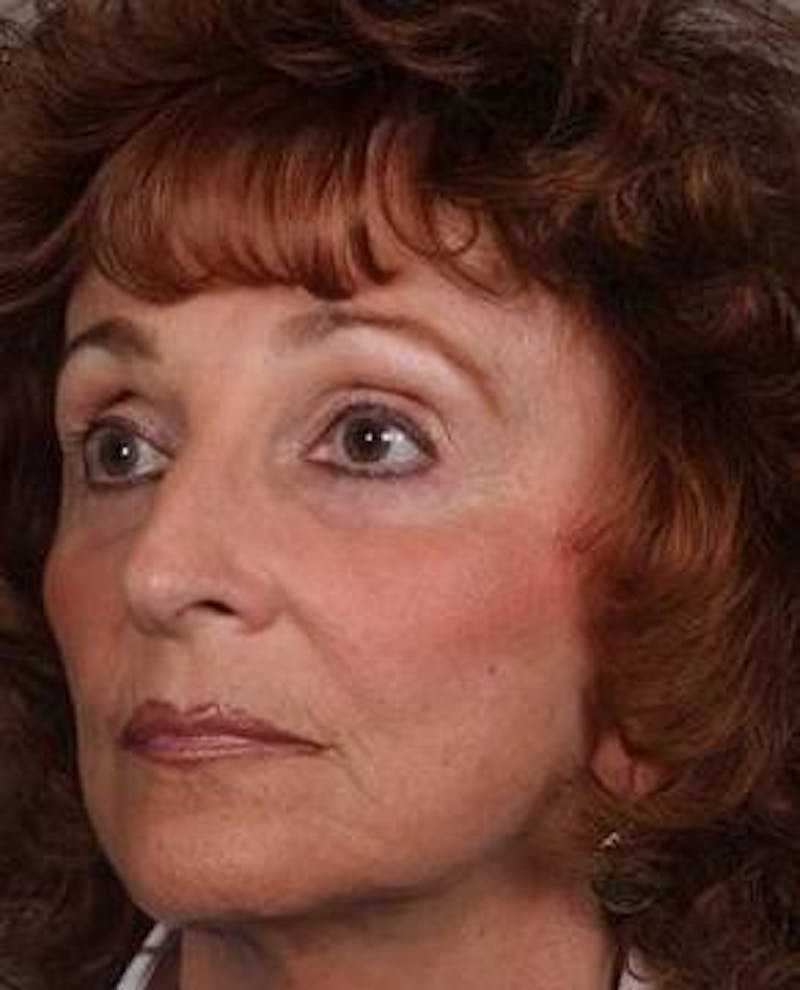Dermal Fillers Before & After Gallery - Patient 301639 - Image 4 - Scott Chapin, MD