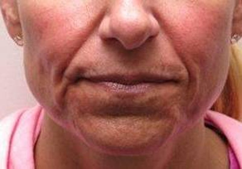 Dermal Fillers Before & After Gallery - Patient 721572 - Image 1 - Scott Chapin, MD