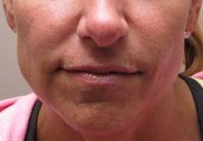 Dermal Fillers Before & After Gallery - Patient 721572 - Image 2 - Scott Chapin, MD